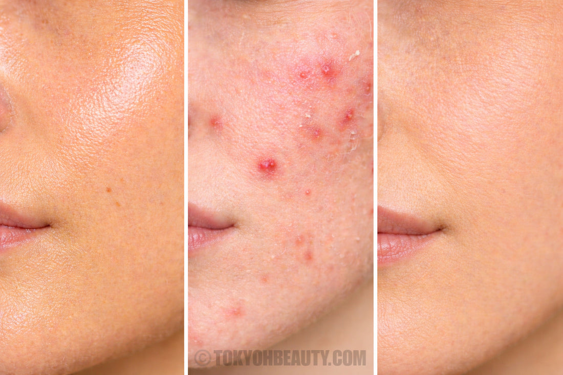 Pelle grassa o acneica? Come riconoscere il tuo tipo di pelle (e perché potresti sbagliarti)